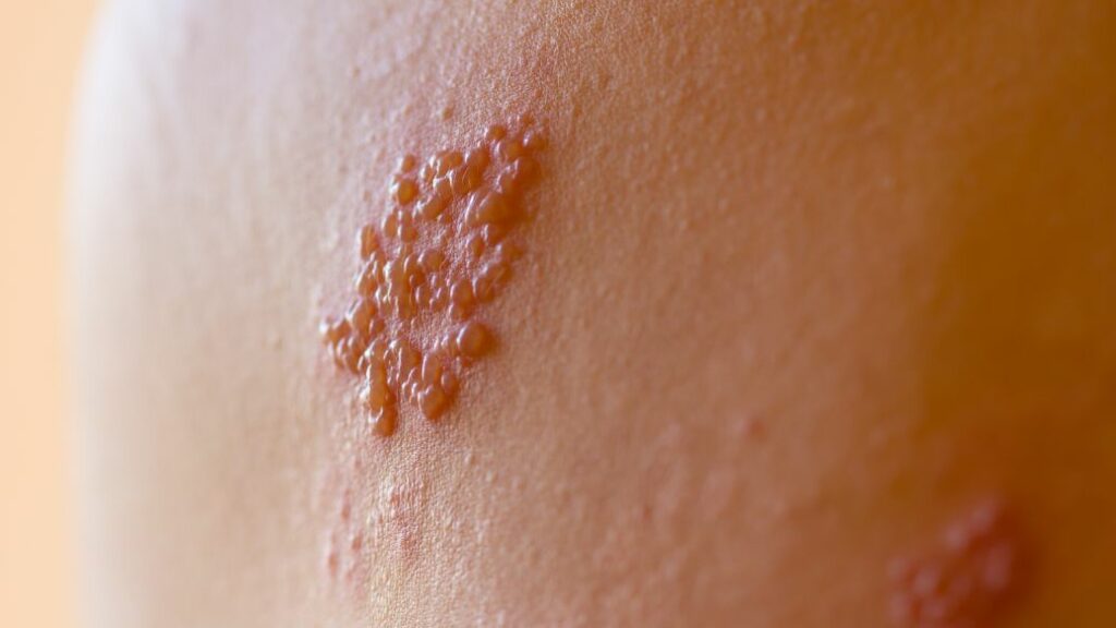 Genital Herpes
