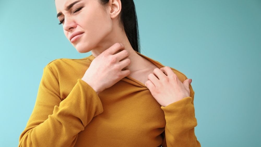 hives treatment online